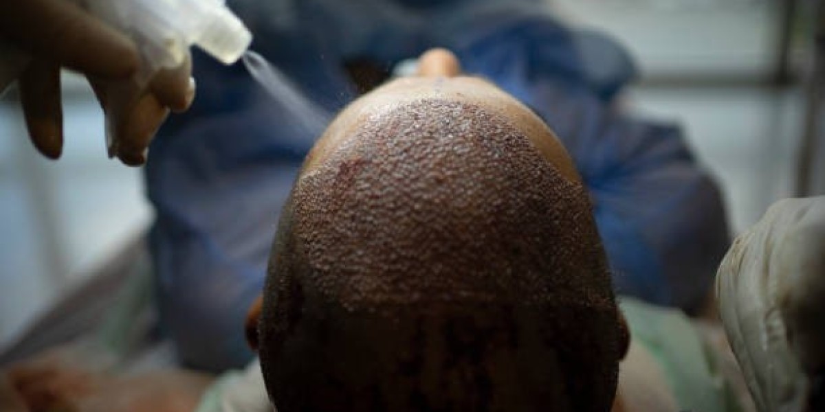 Choosing the Best Hair Transplantation Technique for Your Needs